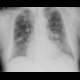 Bronchoinvasive aspergillosis, aspergillosis: X-ray - Plain radiograph